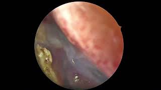 Endoscopic DCR by Amine ENNOUALI MD part 1 [upl. by Enilegnave]