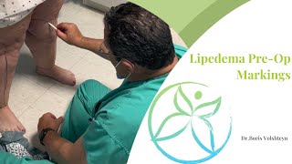 Preoperative Markings for Lipedema Liposuction  Lower Extremities  Dr Boris Volshteyn [upl. by Nonnair633]