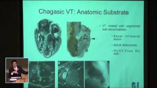 Manejo del paciente con arritmia ventricular quotchagásicaquot [upl. by Dragone]