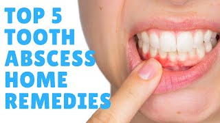 Tooth Abscess Top 5 Tooth Abscess Home Remedies amp Treatments  GET FAST RELIEF [upl. by Sacks]