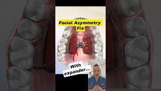 Fixing Facial Asymmetry with a Palate Expander Heres How dentallan dentist shorts [upl. by Emmaline412]