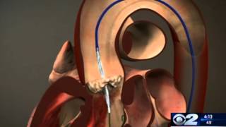 Aortic valve replacement without open heart surgery [upl. by Zed]