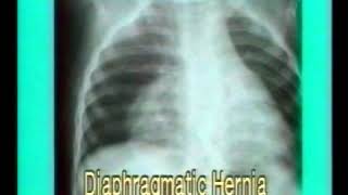 38 Diaphragmatic Hernia and Eventration  Chest XRays  Dr Vaidya [upl. by Timus786]