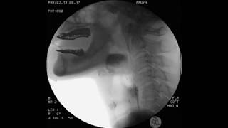 Large epiglottic cyst preop 12 [upl. by Myles]