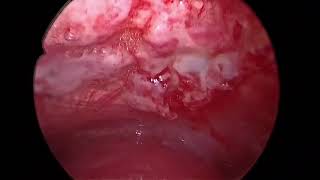 Rigid Thoracoscopy  Pleural Biopsy  Talc Poudrage  Malignant Pleural effusion [upl. by Anaicilef]