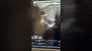 Multinodular Goitre TIRAD4 reels ultrasound neck goitre videos ultraradiology [upl. by Yhtir554]