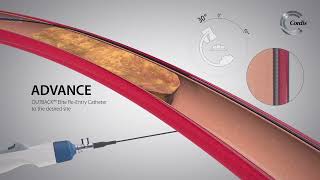 OUTBACK™ Elite ReEntry Catheter Product Highlights [upl. by Nedap]