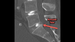 Toxic Annular Tears  Part 1 of 3 Symptoms and MRI [upl. by Nothgierc]