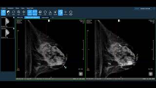 Koning Clinical Overview Invasive Ductal Carcinoma with DCIS Calcifications and Mass [upl. by Anetsirhc200]