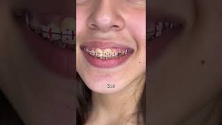 Braces Colors Before and after 8 weeks [upl. by Bellina]