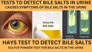 BILE SALTS IN URINEHAYS TEST TO DETECT BILE SALTS IN URINE IN HINDIBILEPIGMENTS IN URINE [upl. by Oiznun609]