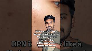 DPN removal from Face  Is it harmful Skin tag  மரு  Dr Thamizhinian  Dermatologist skintags [upl. by Olson]