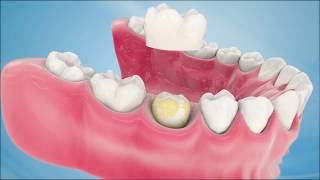 Dental Crown Procedure [upl. by Fabyola]