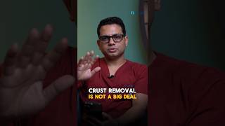 Is it safe to remove crusts at home  Explained by Dr Jangid [upl. by Lukin]