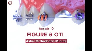 Figure 8 Oti Asker Orthodontic Minute Episode 6 [upl. by Teak]