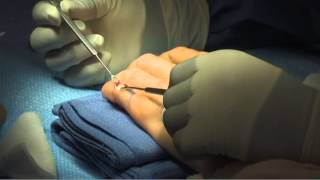 Treatment of Chronic Mallet Finger by Leo Rozmaryn MD [upl. by Ellerehs650]