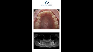 Impacted canine tooth  Surgical exposure  Braces Geelong Orthodontist [upl. by Per]