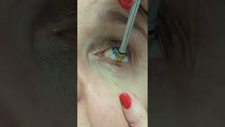 Cryosurgery of eyelid papilloma  Кріохірургія папіломи повіки  Криохирургия папилломы века [upl. by Eddra890]