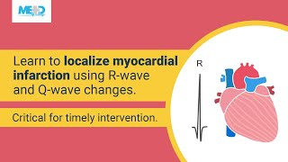 How to localize myocardial infarction based on RWave shrinkage and Qwave development [upl. by Suraved]