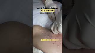 Neck and decolletage boosters✨ ｜DR D AESTHETICS CLINIC SINGAPORE [upl. by Licha756]