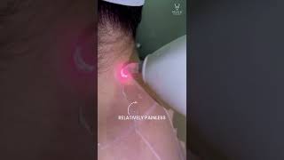 Laser hair removal mark for precision save target Area relatively painless [upl. by Einahpehs]