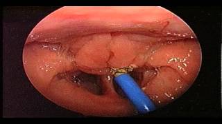 Adenoidectomy Surgery  Removal Of Adenoids  ENT Consultant London  ENT Surgeon London [upl. by Apgar]