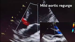 Takayasu Arteritis [upl. by Emalee968]