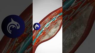 See how an Angioplasty and Stent Placement work in 3D animation [upl. by Ecinuahs]