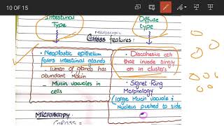 Gastric Carcinoma  Pathology [upl. by Jangro]