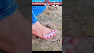 فوائد موزع اصابع القدم  علاج الوكعة bunions  halluxvalgus [upl. by Rolfston]