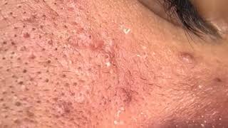 how to remove forehead pimples in one day  white blackheads on face  comedones treatment [upl. by Araas301]