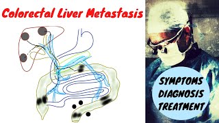 Stage 4 Colon Cancer Liver Metastasis Symptoms Diagnosis Treatment [upl. by Okomot52]