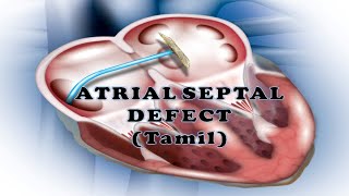 ATRIAL SEPTAL DEFECT ASDTAMIL  TYPES  HEMODYNAMICS HEART SOUND  ASD INVESTIGATION MANAGEMENT [upl. by Healy]