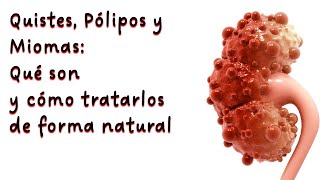 Quistes Pólipos y Miomas Qué son y cómo tratarlos de forma natural por Nely Helena Acosta Carrillo [upl. by Lorin]