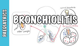 Bronchiolitis causes pathophysiology signs and symptoms treatment [upl. by Loesceke]