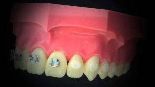 Biodinâmica  Biofix Adesivo para fixação de brackets com fluorescência [upl. by Ahsiek]