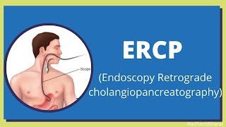 Endoscopic retrograde cholangiopancreatography ERCP [upl. by Sidonius]