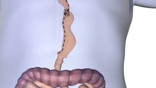 Esophagectomy Procedure Animation [upl. by Levitus]