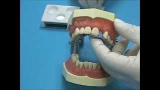 SuperBond CampB Direct Bonded Bridge using the Brushdip Technique [upl. by Enilrahc]