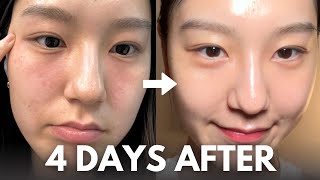 How I repair my skin barrier in 4 days at home with affordable skincare routine [upl. by Bael]