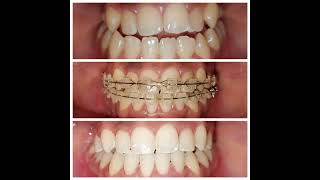 Class III Malocclusion Non Surgical treatment wwwalignersbracescom Ph 9900008081 [upl. by Eicirtap264]