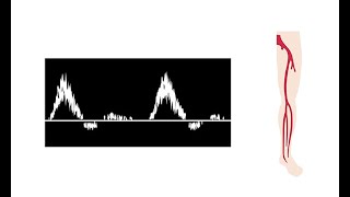 Interpreting duplex waveforms [upl. by Seda49]