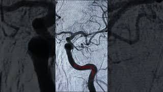 Cerebral Angiogram  Session 3 [upl. by Anoek]