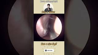 rhinorrhea sinusitis bersihkankuping satisfyingvideos pembersihan telinga video puas hati [upl. by Rosalynd193]