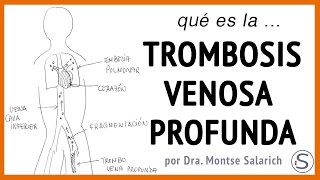 Trombosis Venosa Profunda [upl. by Fitzsimmons]