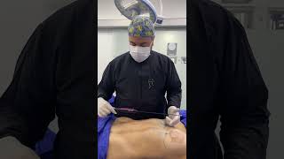 Flacidez abdominal  Liposucción con Renuvion Cirugíaplástica [upl. by Cheyne]