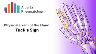 Rheumatology HAND exam Tuck Sign for Extensor Tenosynovitis [upl. by Croft958]