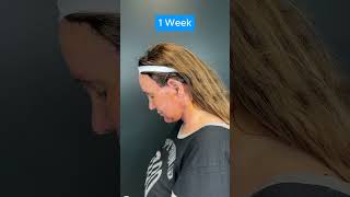 HUGE FACELIFT TRANSFORMATION 2 Week Update [upl. by Phox115]