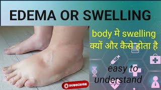 Edema or Swelling Edema kya hota hai Cause of Edema Pathophysiology of edema [upl. by Farlie]