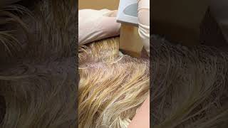 Scalp Treatment for Dandruff Removal [upl. by Htebizile]